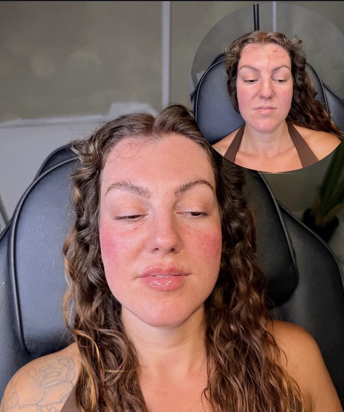 Skin treatment before and after at Clinique Modèlè Aesthetics