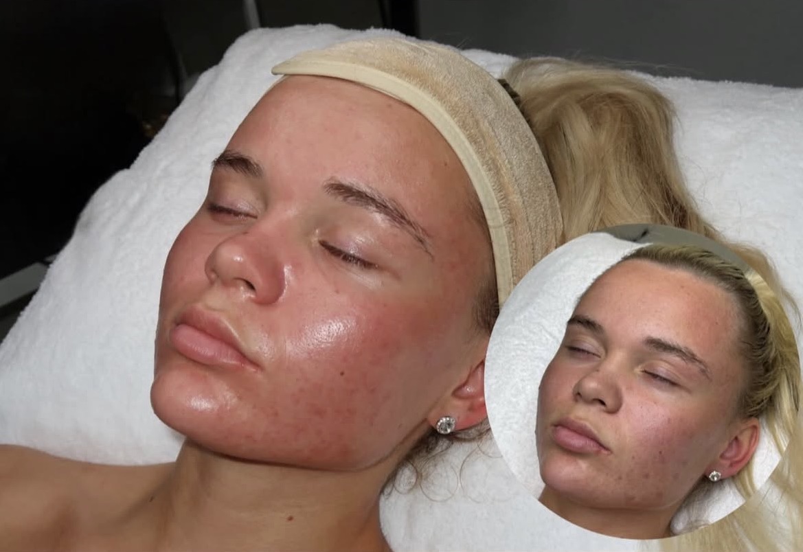 Facial before and after at Clinique Modèlè Aesthetics