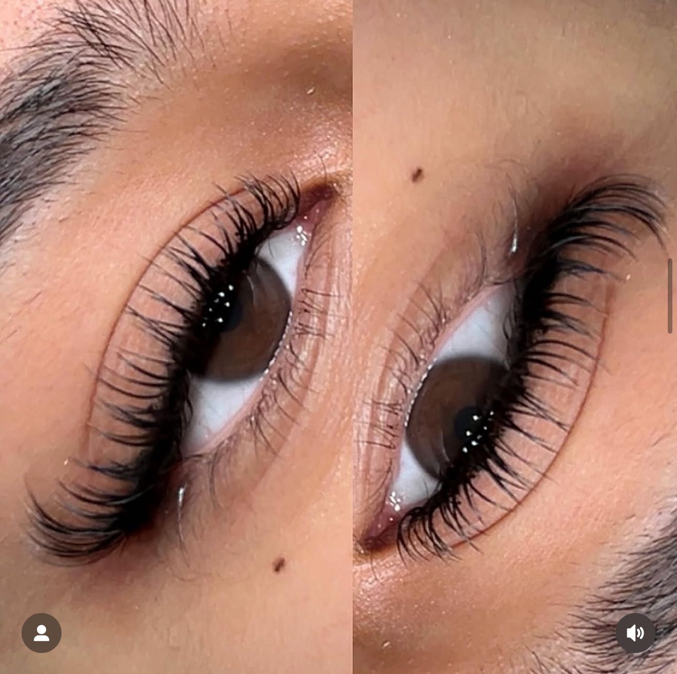 Skin treatment result at Clinique Modèlè Aesthetics