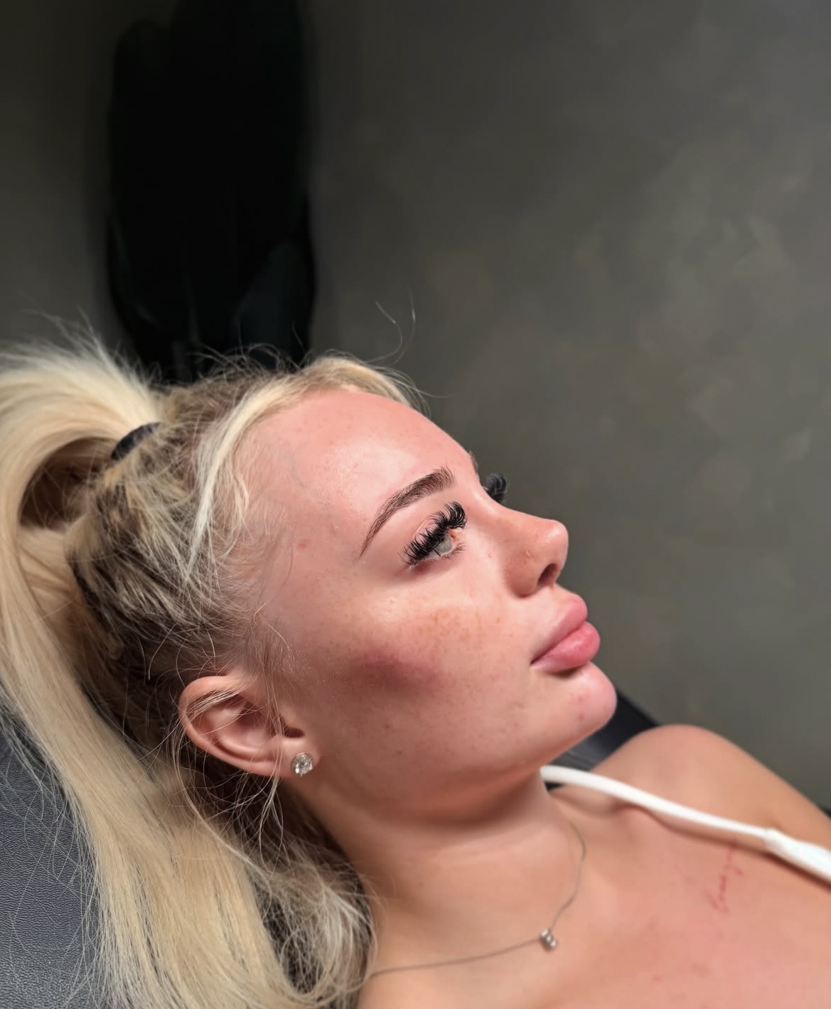 Cheek filler and lash result at Clinique Modèlè Aesthetics