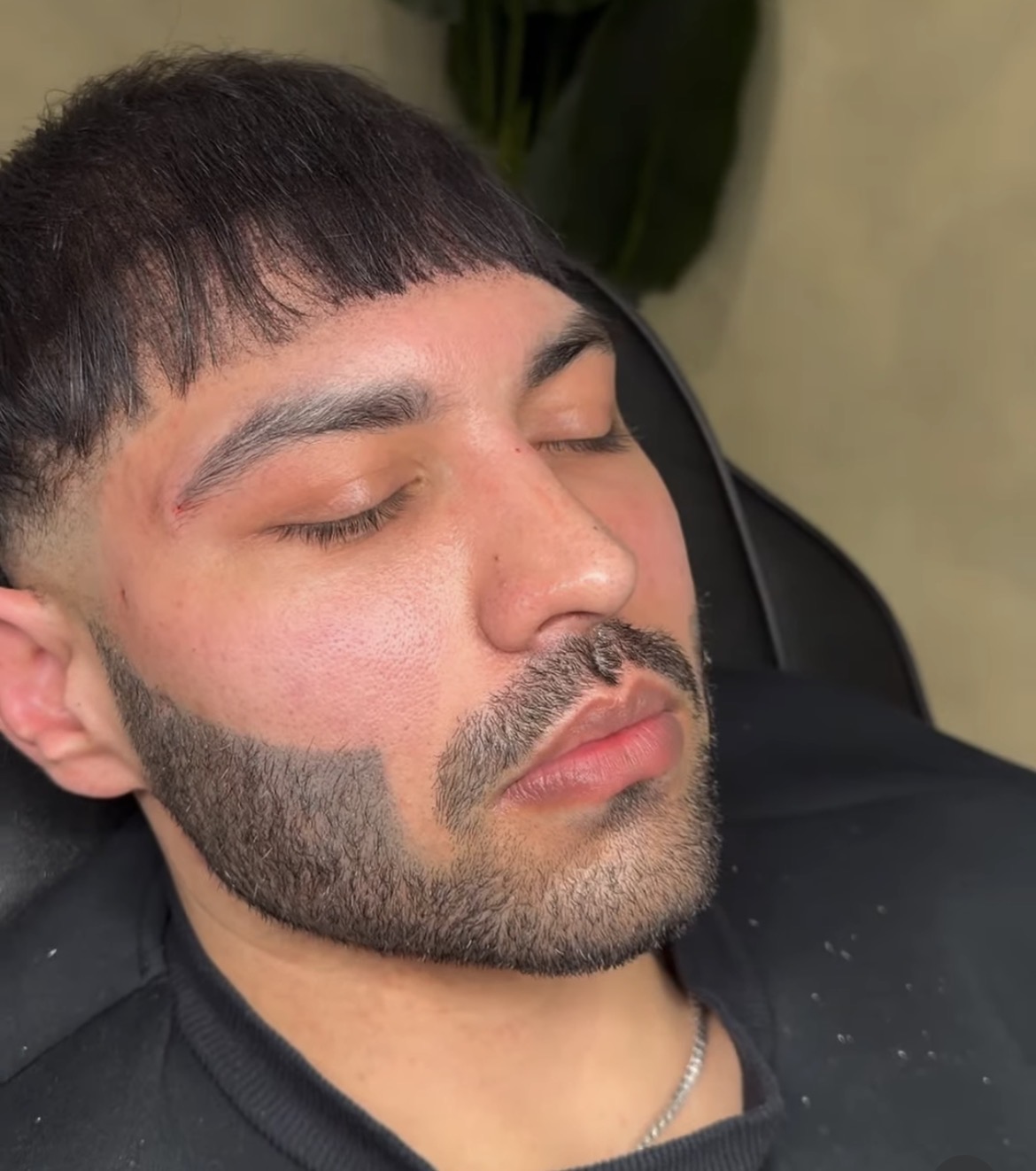 Anti-wrinkle treatment result