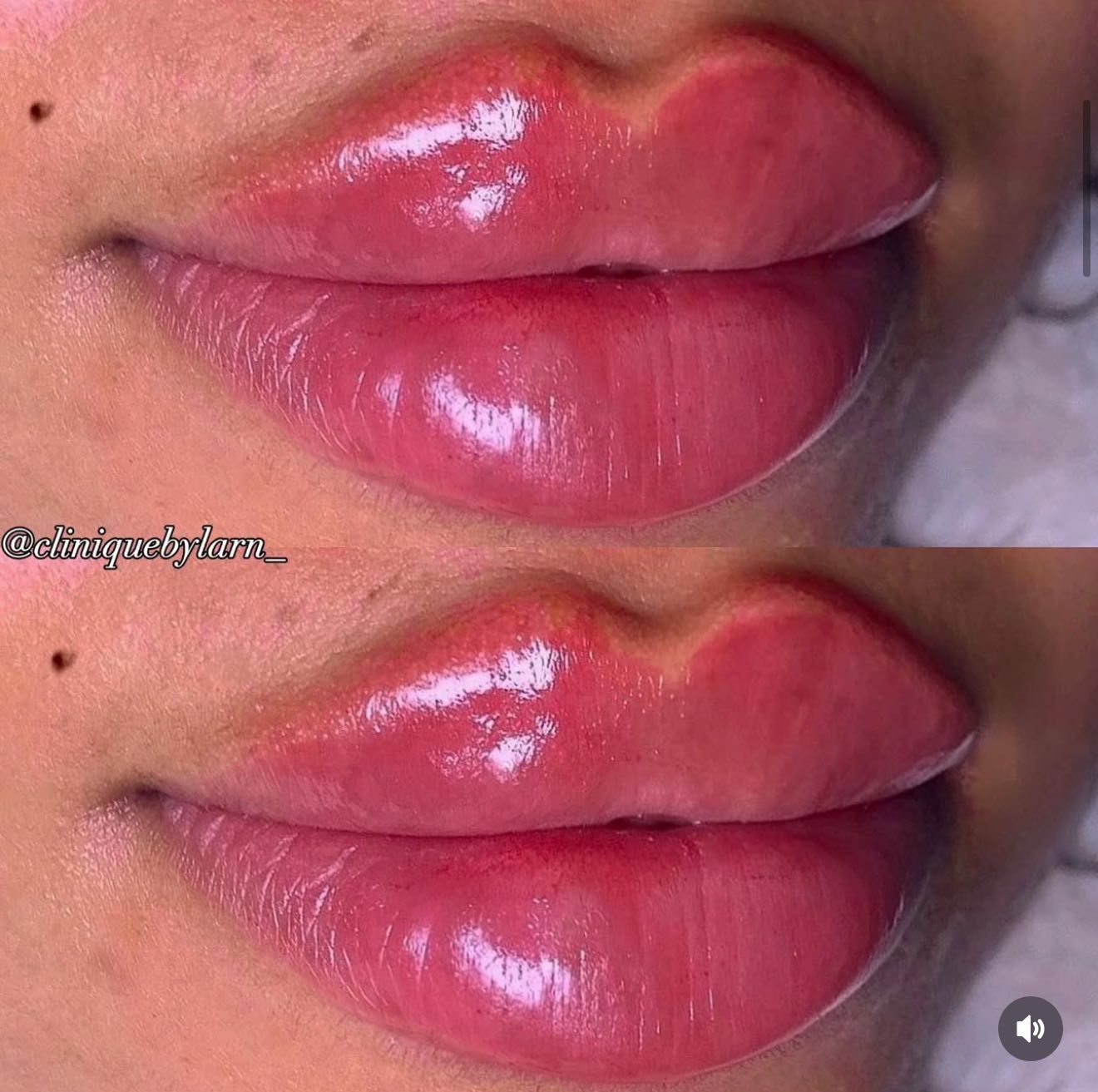 Lip enhancement result at Clinique Modèlè Aesthetics