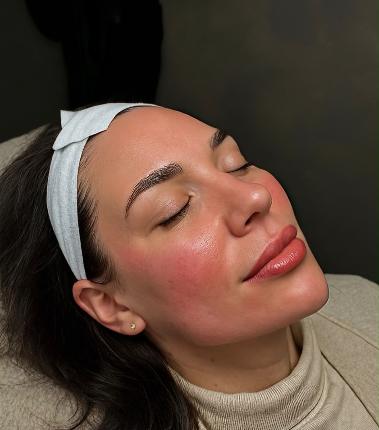 Dermal filler result